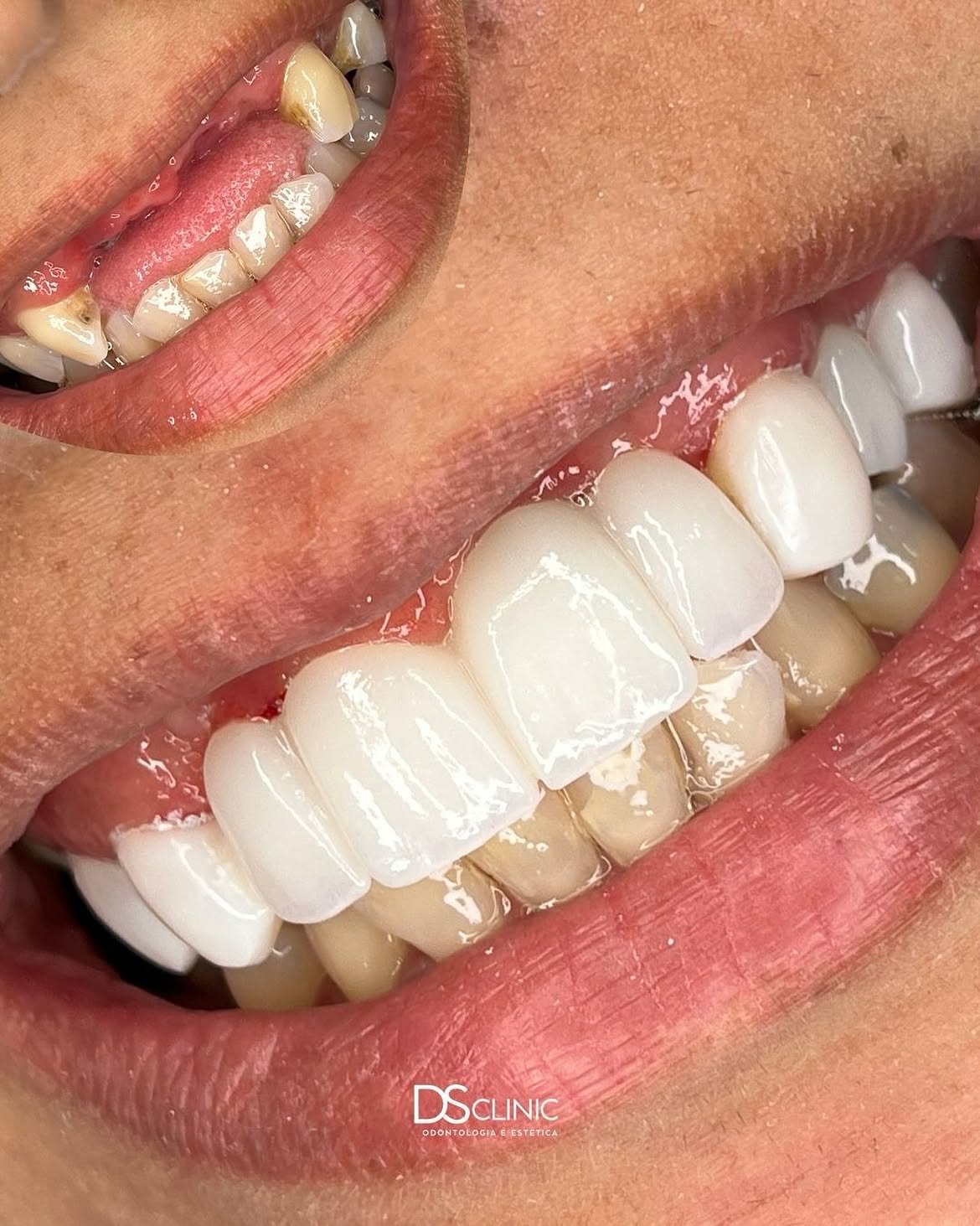 Antes e depois de reabilitação oral